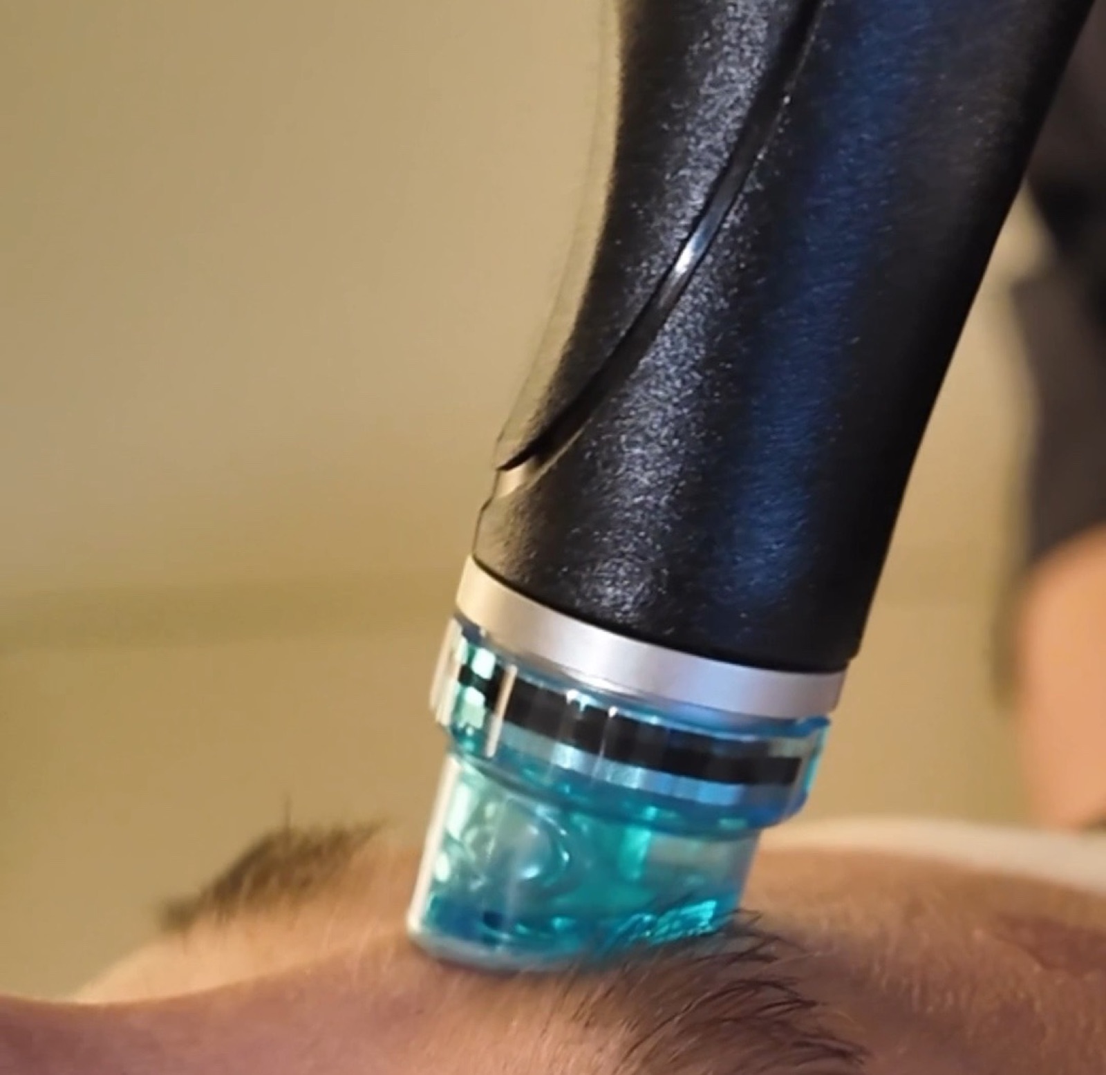 HydraFacial an der Stirn