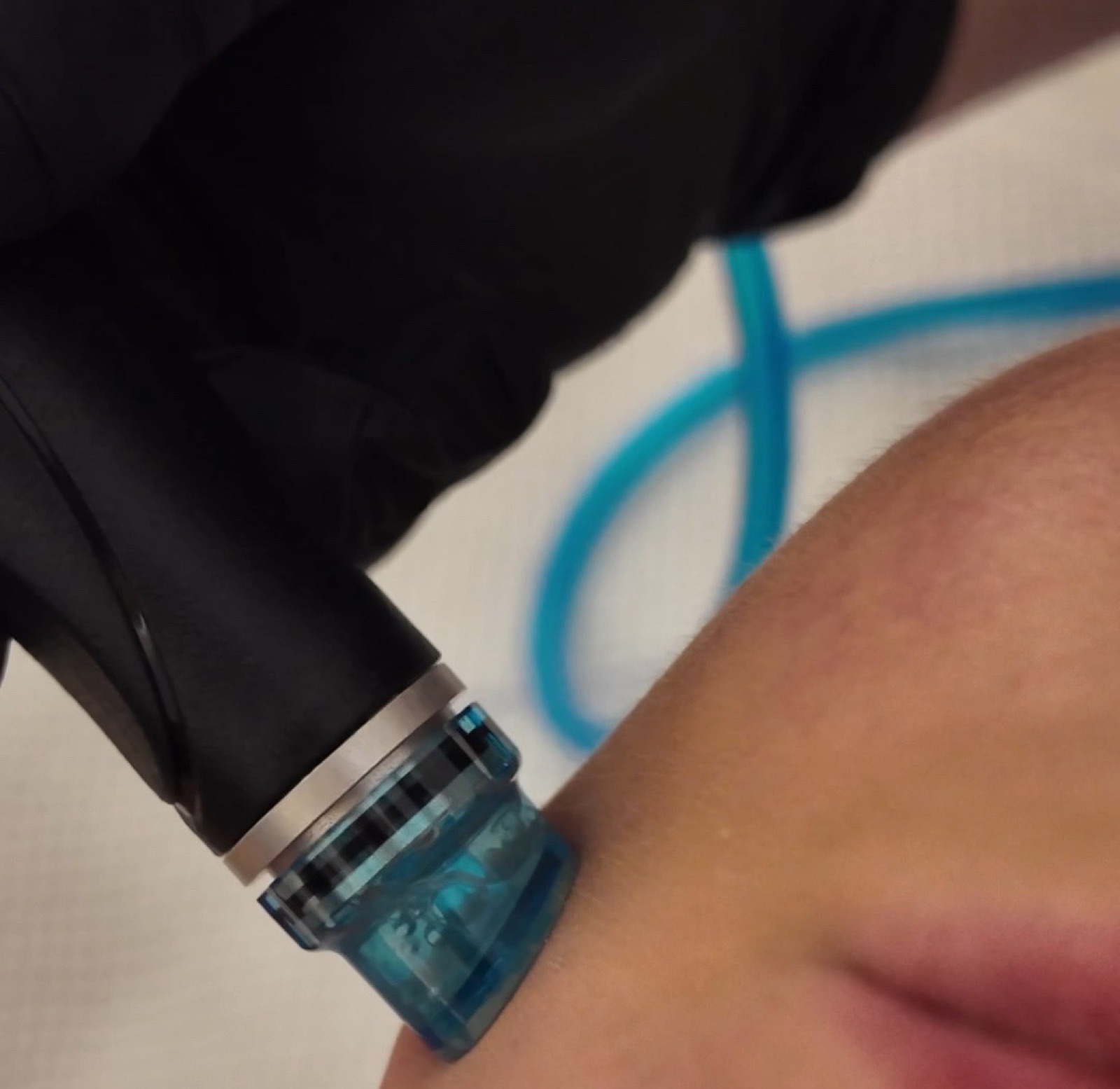 HydraFacial an der Wange